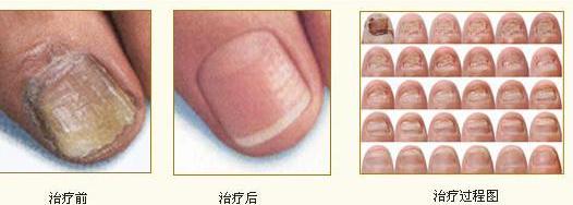 肢端型白癜风病因治疗前后对比图