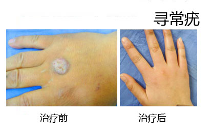 散发型白癜风症状治疗前后对比图