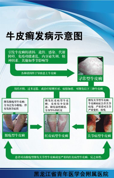 寻常型白癜风病因病因示意图